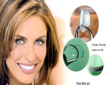 Veneers